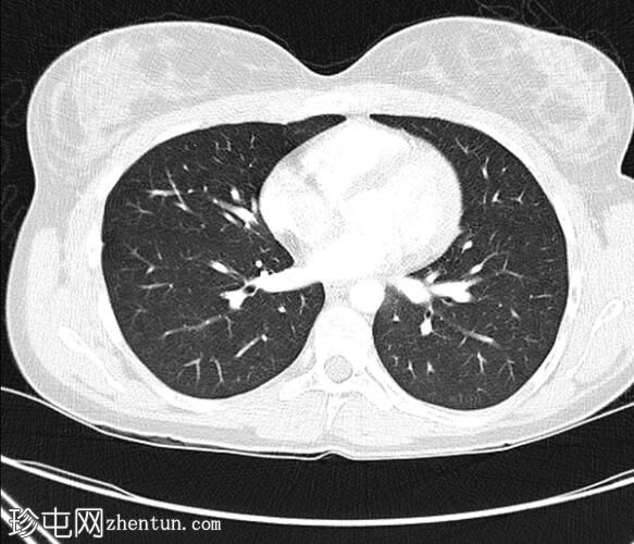 CTPA 诊断肾血管平滑肌脂肪瘤破裂导致胸膜炎性胸痛