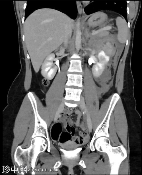 CTPA 诊断肾血管平滑肌脂肪瘤破裂导致胸膜炎性胸痛