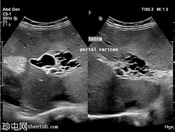门静脉海绵样变性