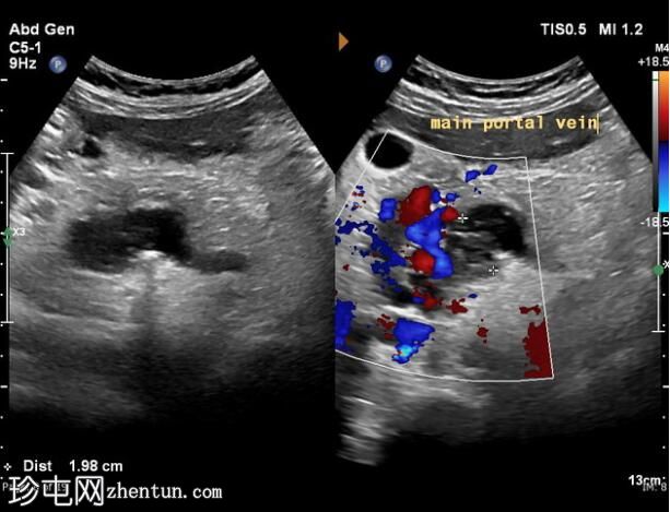 门静脉海绵样变性