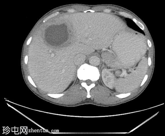 肝脓肿伴肝静脉血栓形成