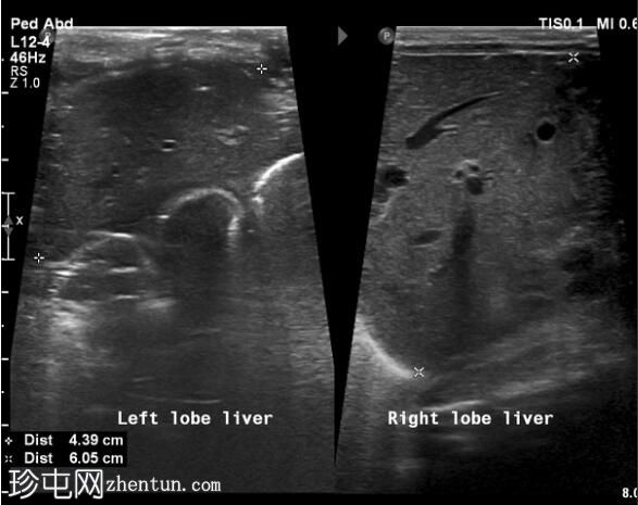 脐静脉导管相关的肝液收集（TPNoma）和脓肿形成