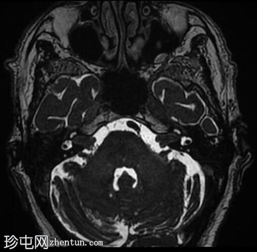 腮腺腺样囊性癌神经周围肿瘤扩散