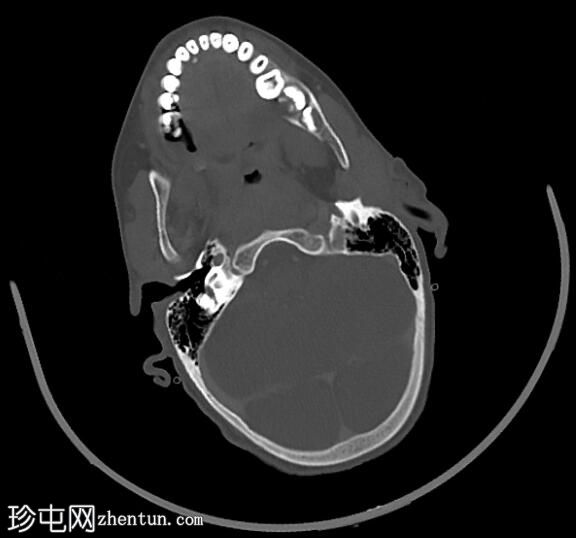 唾液石症和唾液腺炎