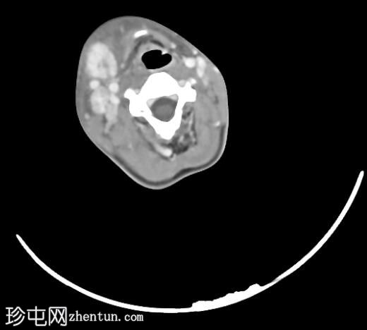 唾液石症和唾液腺炎