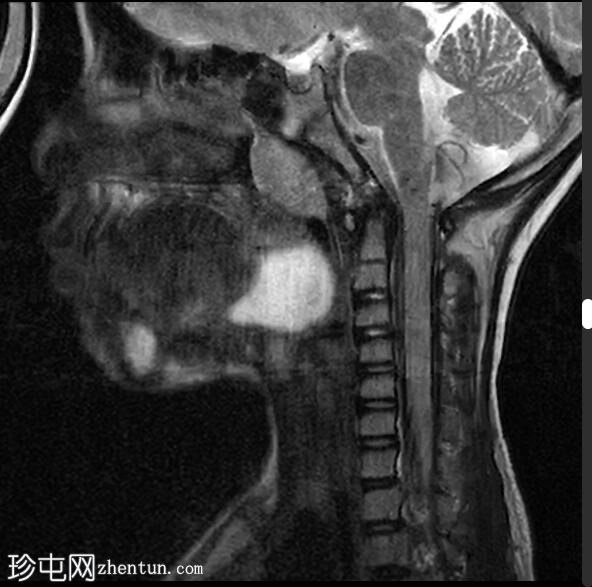 舌甲状舌管囊肿