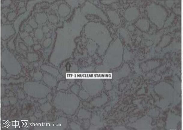 大颅骨转移：原发性滤泡性甲状腺癌