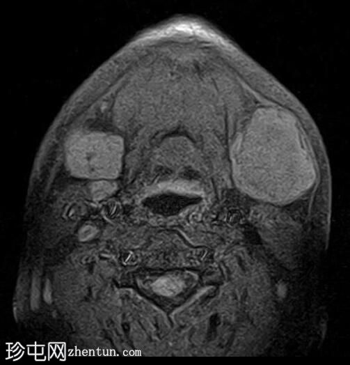 多形性腺瘤-下颌下腺