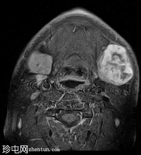 多形性腺瘤-下颌下腺