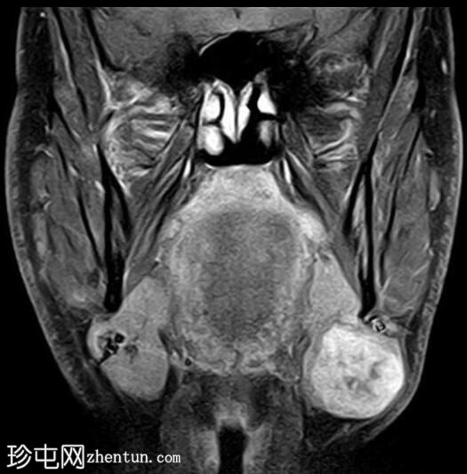 多形性腺瘤-下颌下腺