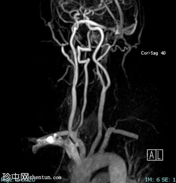 椎动脉夹层
