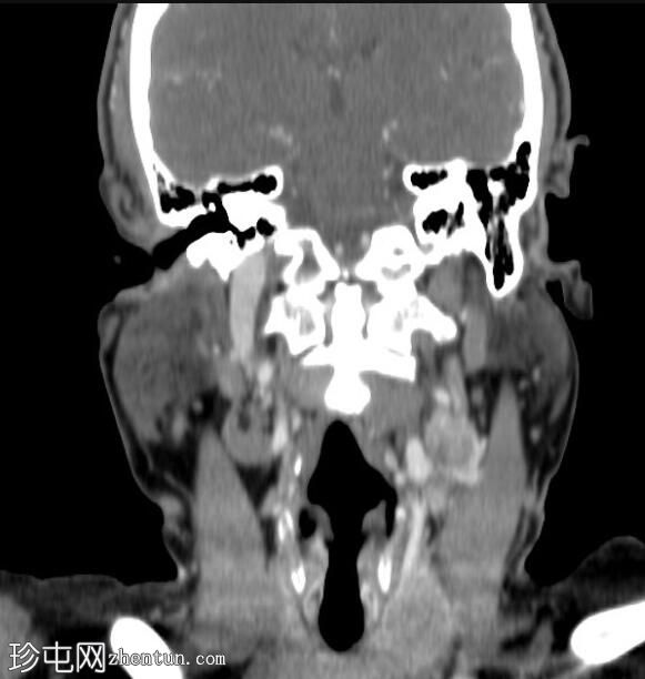 甲状腺髓样癌