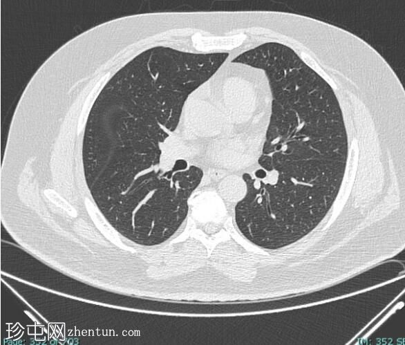 甲状腺髓样癌