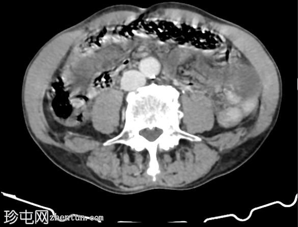 SMA 栓塞伴肠系膜缺血、脾脏和肾梗死