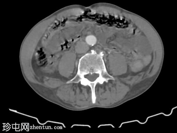 SMA 栓塞伴肠系膜缺血、脾脏和肾梗死