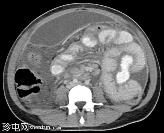 结核性腹膜炎