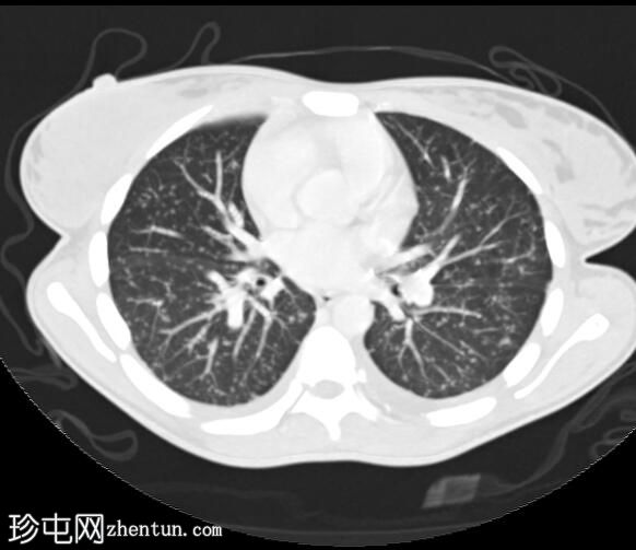 结核性腹膜炎