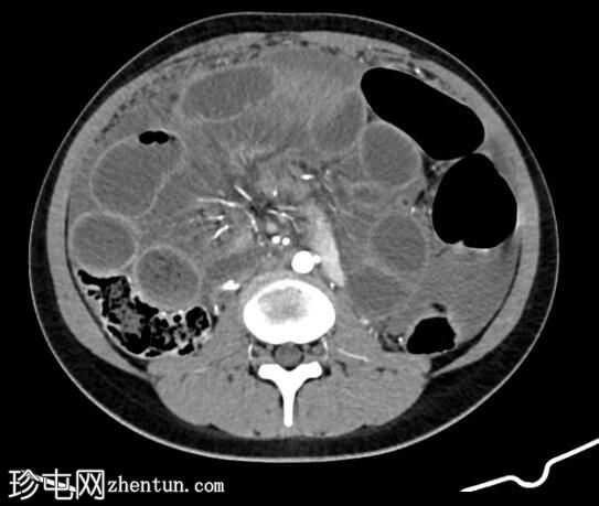 结核性腹膜炎引起闭环小肠梗阻