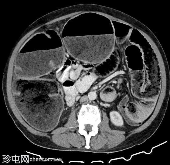 “苹果核”结肠腺癌伴有梗阻和粪便化