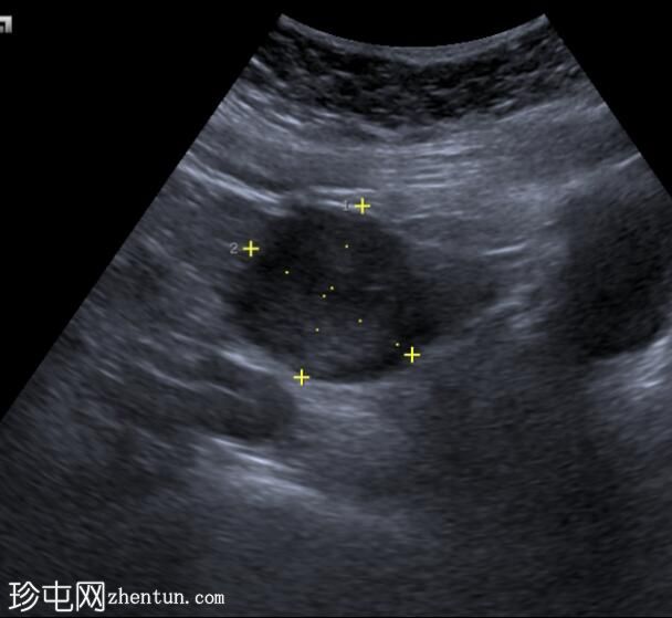 卵巢子宫内膜异位症 - T2 黑斑征