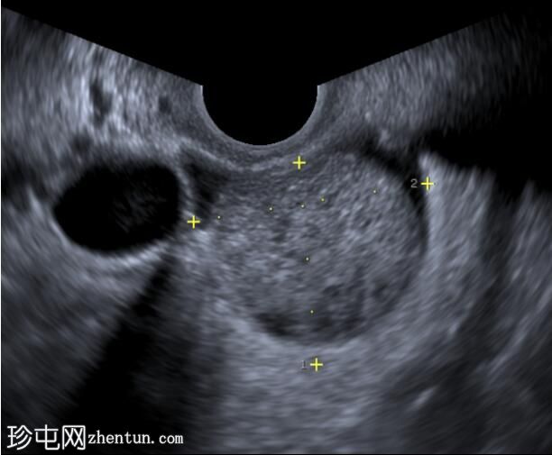 卵巢子宫内膜异位症 - T2 黑斑征