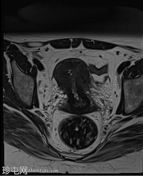 卵巢子宫内膜异位症 - T2 黑斑征