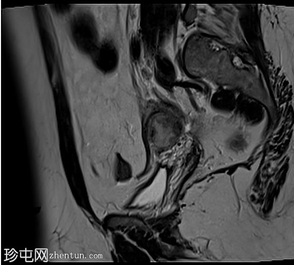 卵巢子宫内膜异位症 - T2 黑斑征