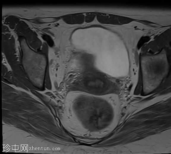卵巢子宫内膜异位症 - T2 黑斑征