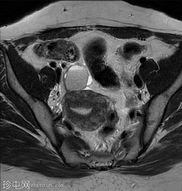 卵巢子宫内膜异位瘤伴对侧皮样囊肿
