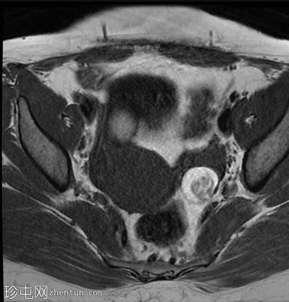 卵巢子宫内膜异位瘤伴对侧皮样囊肿