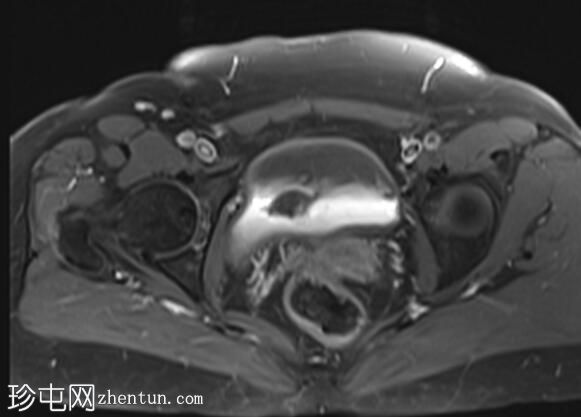 卵巢破裂成熟囊性畸胎瘤
