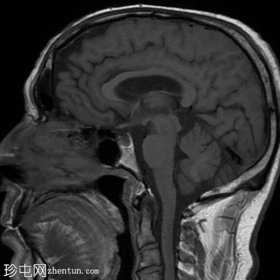 神经结节病、肺和鼻窦结节病