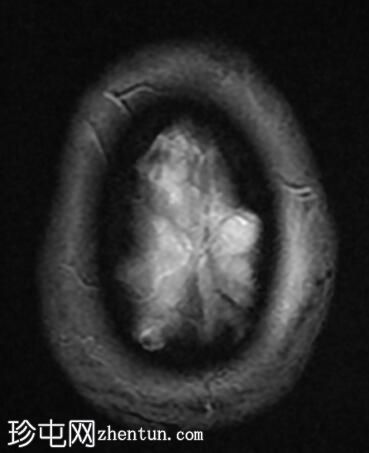 神经结节病、肺和鼻窦结节病