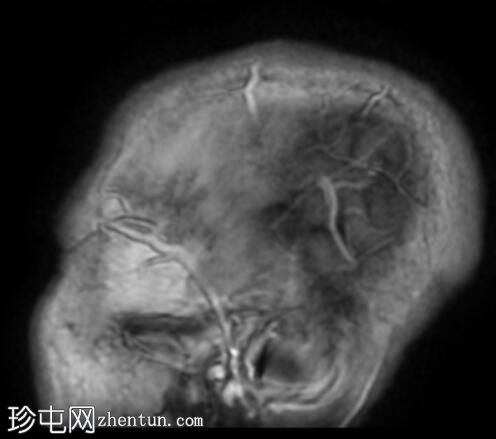 神经结节病、肺和鼻窦结节病