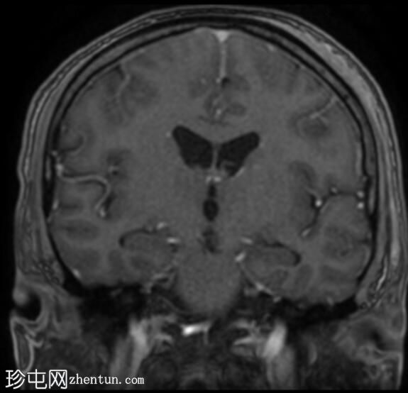 神经结节病、肺和鼻窦结节病