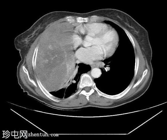胸膜孤立性纤维瘤