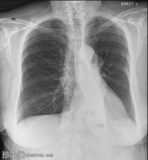 肺癌-左下叶节段塌陷