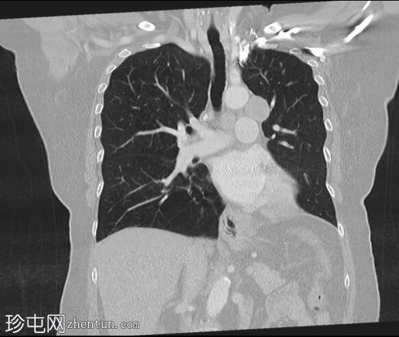 肺癌-左下叶节段塌陷