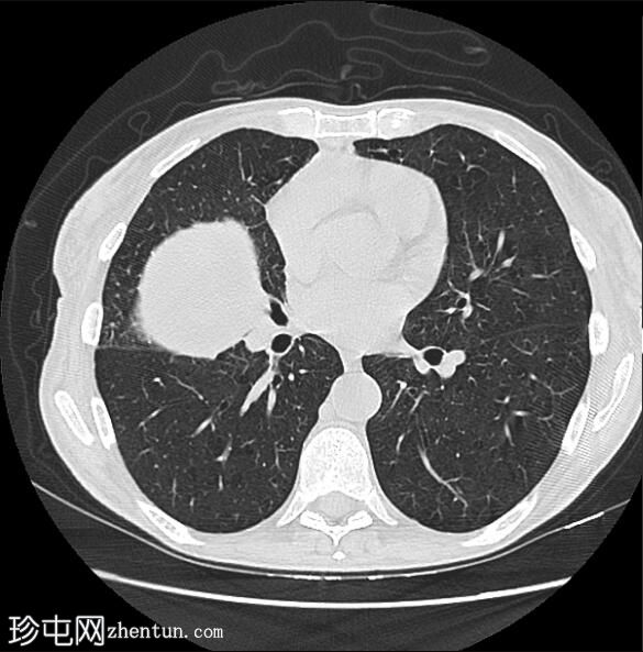 肺鳞状细胞癌和膨裂