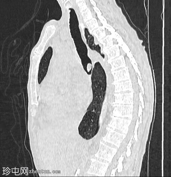 肺鳞状细胞癌和膨裂