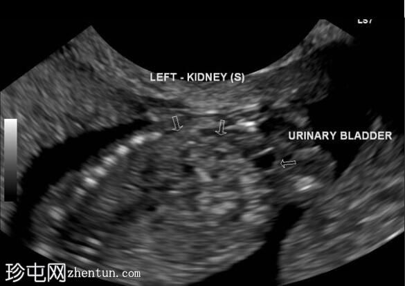 交叉肾异位 - 产前超声检查