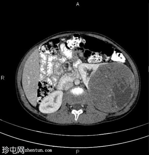肾母细胞瘤