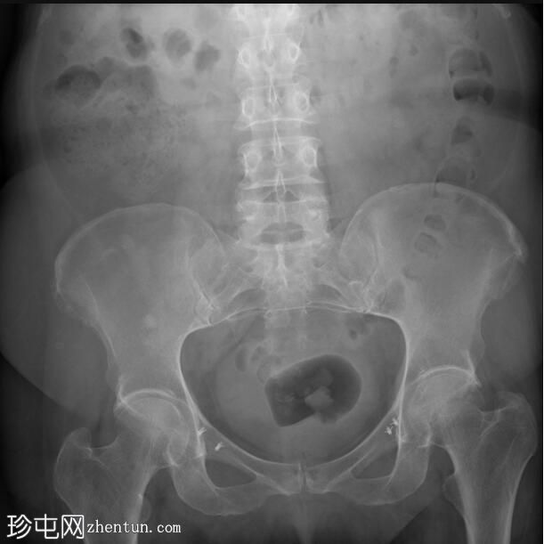 组织骨锚固件在骨盆悬吊（吊带）手术中的应用