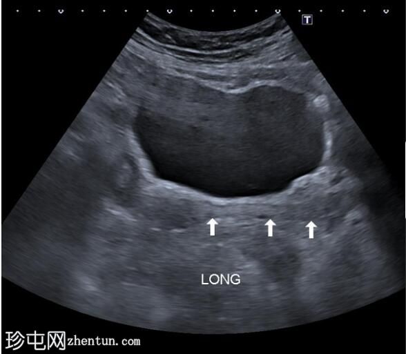 子宫内膜息肉脱垂至整个阴道管