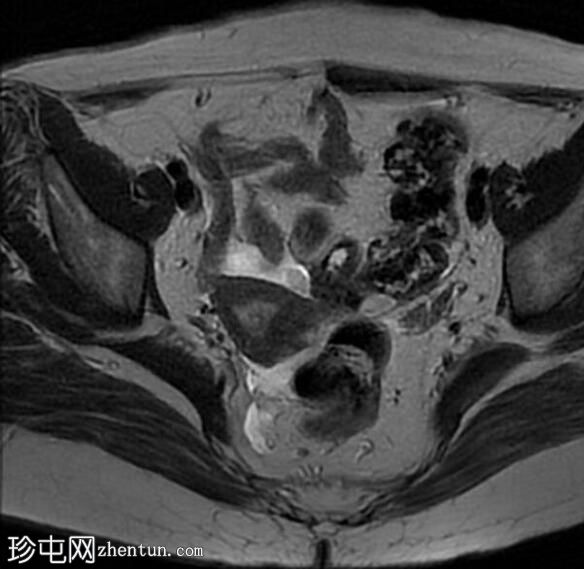 子宫内膜息肉脱垂至整个阴道管