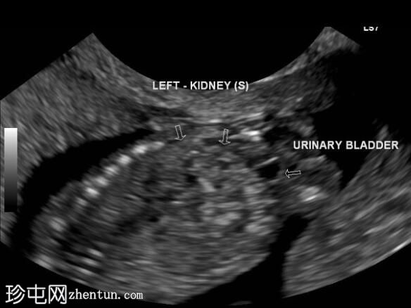 交叉肾异位 - 产前超声检查