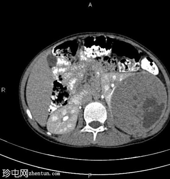 肾母细胞瘤