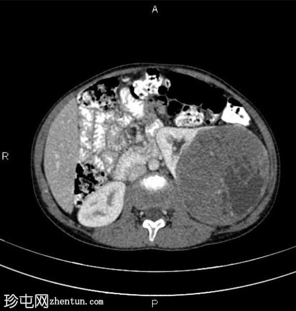 肾母细胞瘤