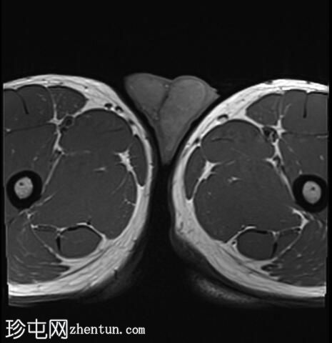 先天性肾上腺增生伴睾丸肾上腺残余