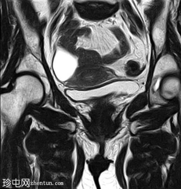 卵巢浆液性包涵体囊肿